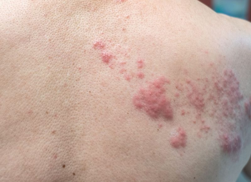 dozdrowia. półpasiec