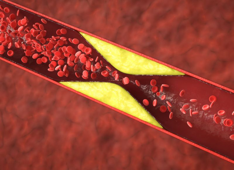 lipoproteina a  dozdrowia.pl