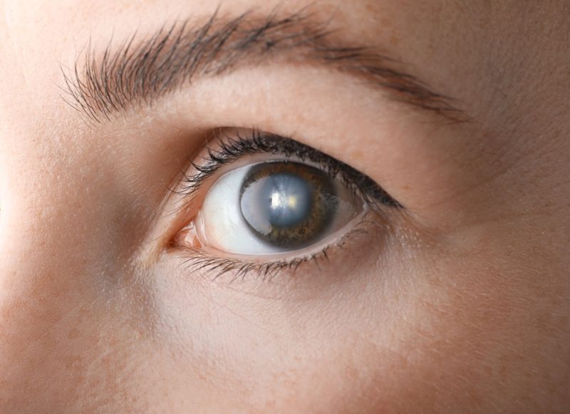 zaćma dozdrowia jak leczyć